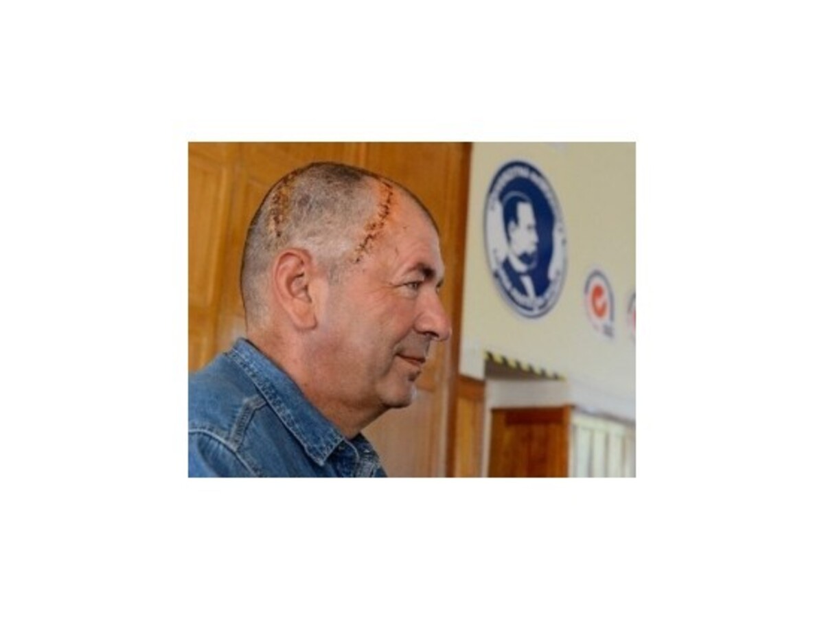 Lekári voperovali pacientovi do lebky unikátny slovenský implantát