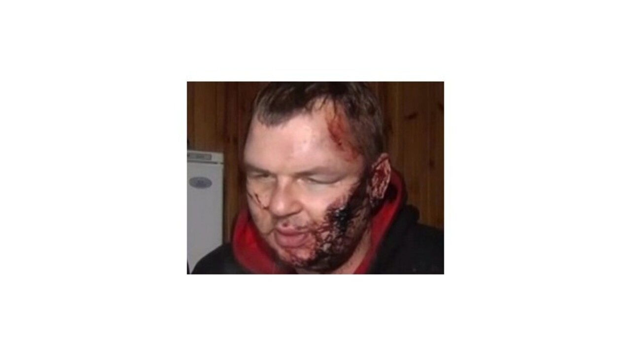 Údajne mučený opozičný aktivista Dmytro Bulatov je v Litve na liečení