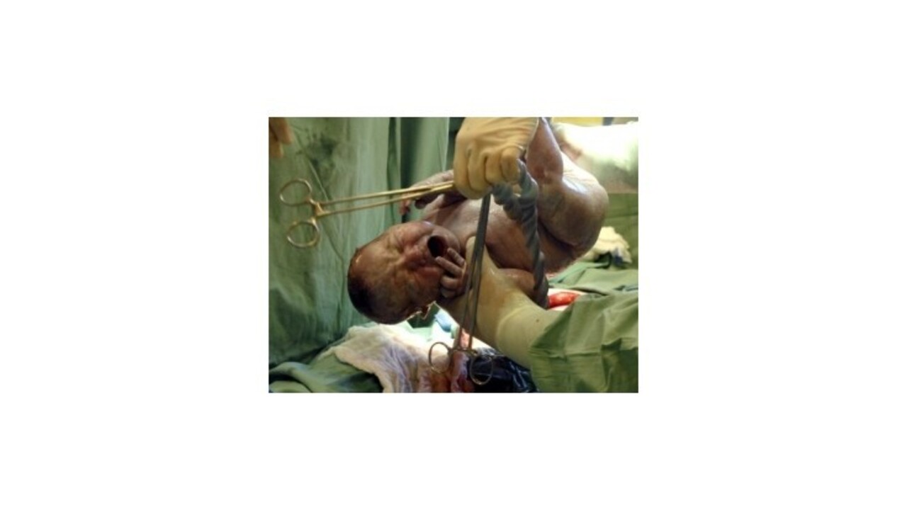 Narodilo sa prvé dieťa z transplantovanej maternice