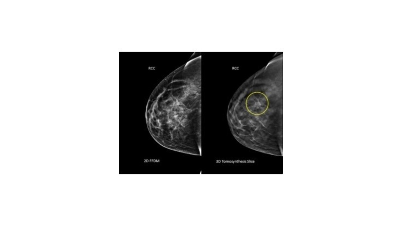 Vedci z Martina vedia predpovedať rakovinu prsníka