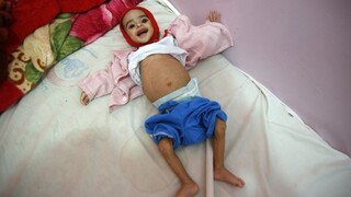 Jemen je na pokraji hladomoru, podvýživou trpia státisíce detí