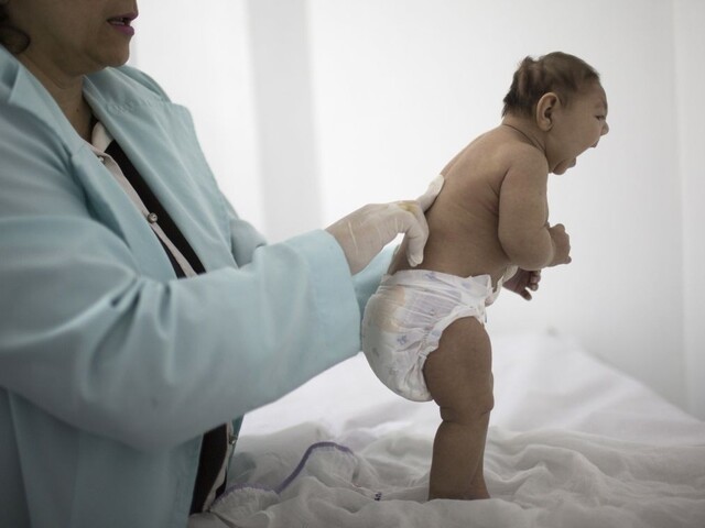 Obavy sa potvrdili. Vírus zika skutočne spôsobuje mikrocefáliu