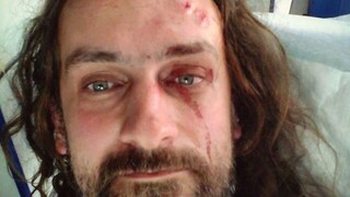 V prípade napadnutia výtvarníka Lorenza začali trestné stíhanie