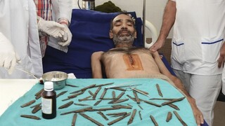 Policajt mal v žalúdku 40 nožov, operácia trvala hodiny