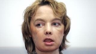 Prvá žena s transplantovanou tvárou zomrela, telo odmietlo implantát