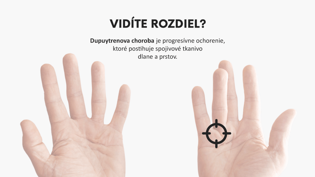 Unikátny liek na Dupuytrenovu kontraktúru - inovácia bez potreby operácie