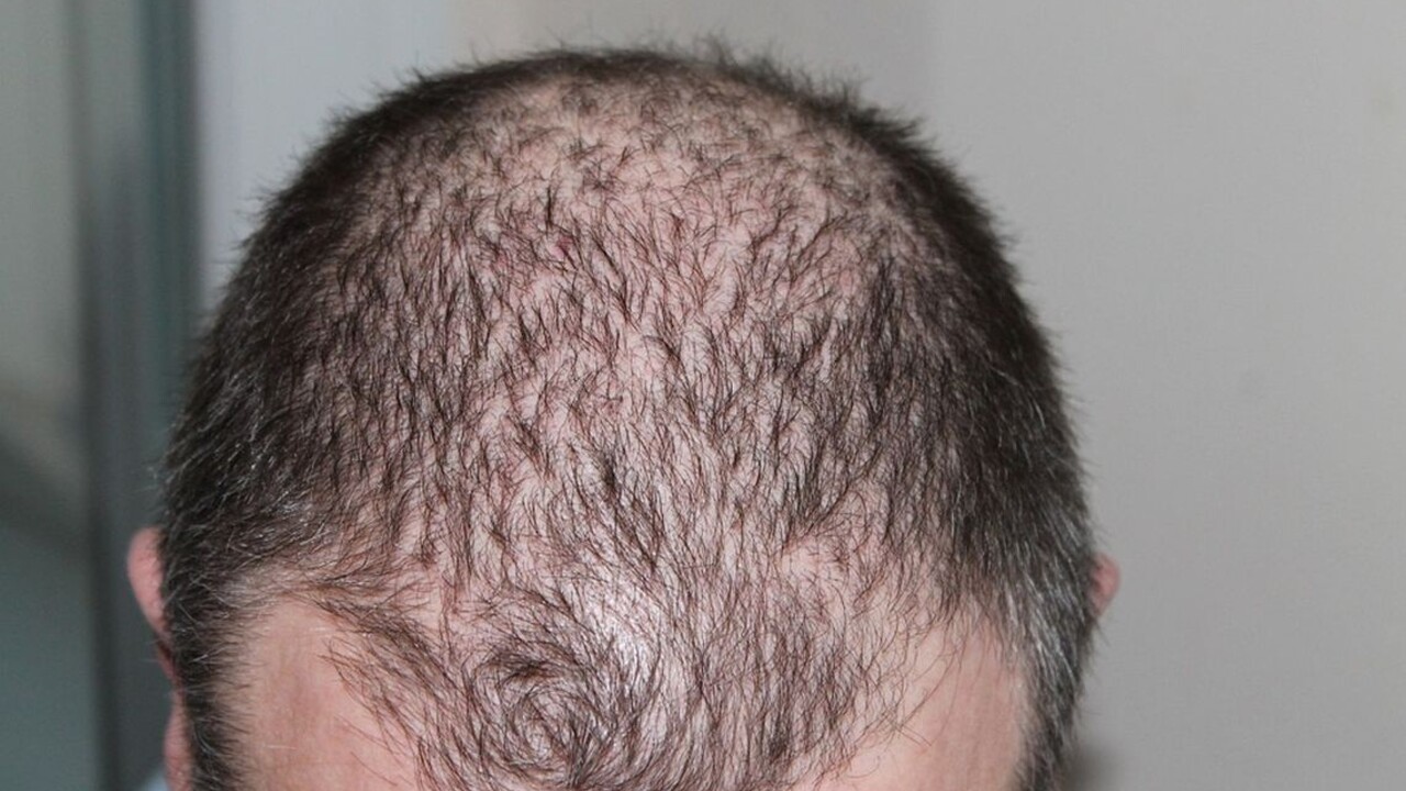 Príčiny, príznaky a liečba vypadávania vlasov. Pomôžu vitamíny a kokosový olej