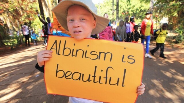 albinism_ac1100ae-6aa1-e1a0.jpg