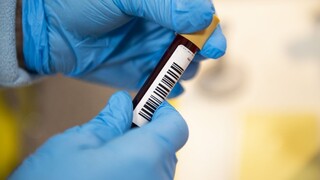 Na východe preveria imunitu, testy na protilátky budú zadarmo