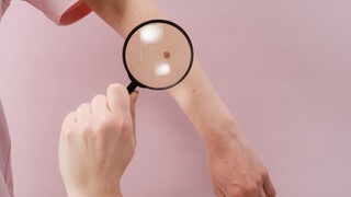 Znepokojujúci trend na Slovensku. Prípady rakoviny kože pribúdajú, záujem o prevenciu našťastie tiež
