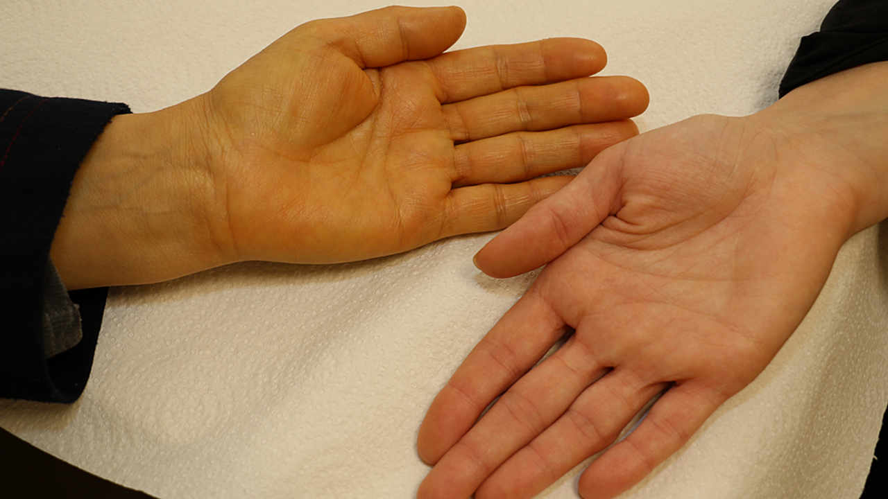 Zožltli vám ruky? Spomeňte si, čoho ste sa prejedli, môžete mať karotenémiu