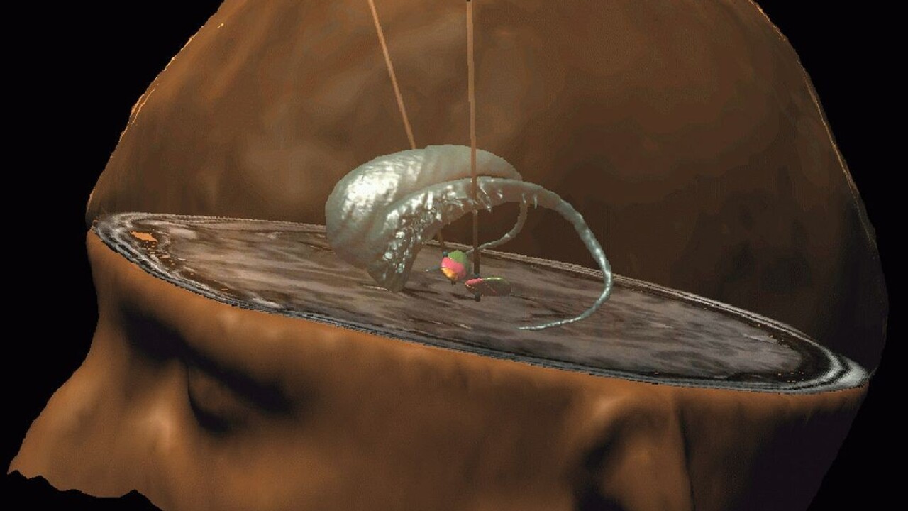 Vedci vytvorili v laboratóriu malé ľudské mozgy s Parkinsonovou chorobu