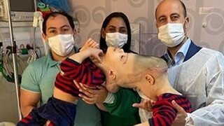 Neuveriteľná práca lekárov. V Brazílii úspešne oddelili siamské dvojčatá, spojené boli lebkou