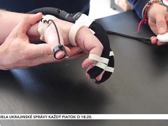 Nové zariadenie môže pomôcť obnoviť funkciu ruky po mozgovej príhode
