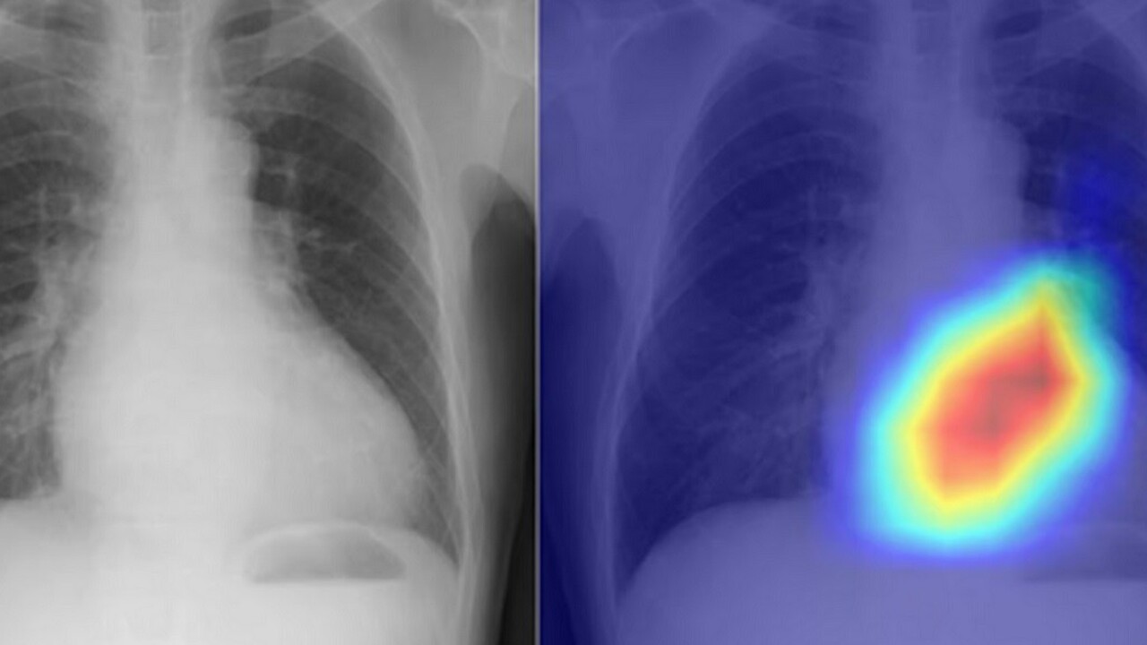 Umelá inteligencia mení röntgen hrudníka na lepší diagnostický nástroj