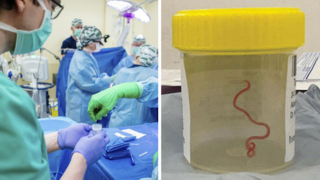 Žena trpela depresiami, lekári jej z hlavy vyoperovali hlísticu. Živú a osem centimetrov dlhú