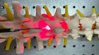 Priama terapia červeným svetlom zlepšuje liečbu poranenia miechy