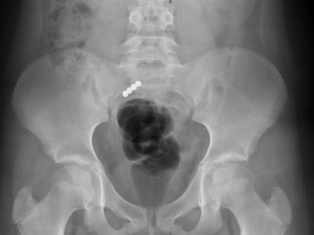 Chceli skúsiť falošný piercing v jazyku. Pre nebezpečnú výzvu na TikToku skončilo päť detí v pražskej nemocnici