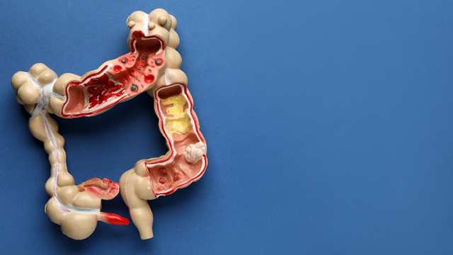 rakovina hrubého čreva hrubé črevo