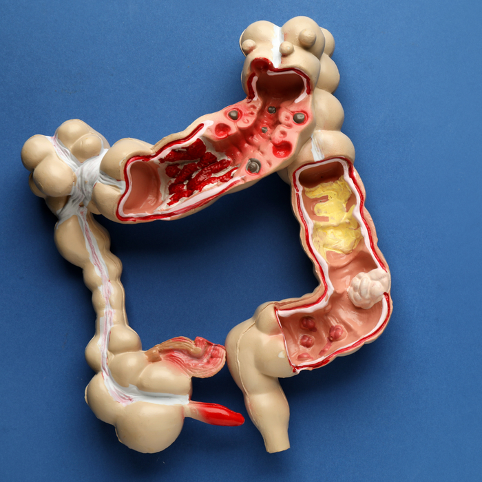 rakovina hrubého čreva hrubé črevo