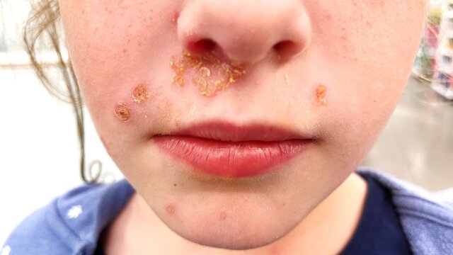 Impetigo