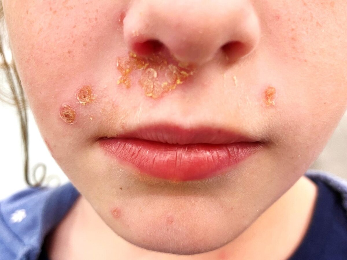 Impetigo