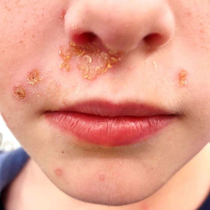 Impetigo