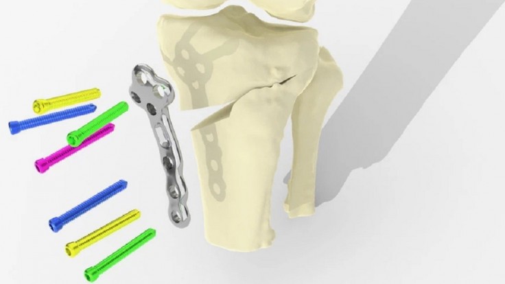 3D tlačená platňa umožní lepšiu a rýchlejšiu operáciu artritického kolena